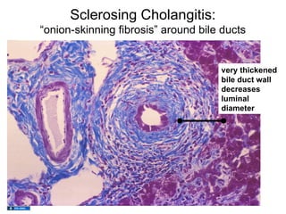 Sclerosing Cholangitis:
“onion-skinning fibrosis” around bile ducts


                                     very thickened
                                     bile duct wall
                                     decreases
                                     luminal
                                     diameter
 