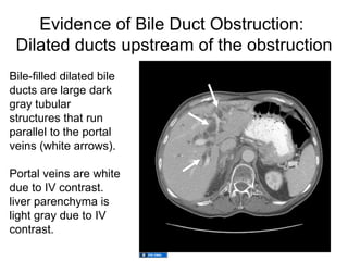 Evidence of Bile Duct Obstruction:
 Dilated ducts upstream of the obstruction
Bile-filled dilated bile
ducts are large dark
gray tubular
structures that run
parallel to the portal
veins (white arrows).

Portal veins are white
due to IV contrast.
liver parenchyma is
light gray due to IV
contrast.
 