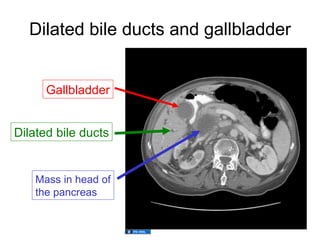 Dilated bile ducts and gallbladder


      Gallbladder


Dilated bile ducts


    Mass in head of
    the pancreas
 