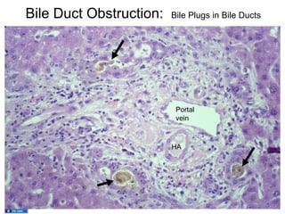 Bile Duct Obstruction:   Bile Plugs in Bile Ducts




                          Portal
                          vein



                         HA
 