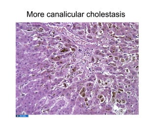 More canalicular cholestasis
 