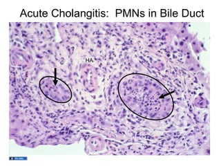 Acute Cholangitis: PMNs in Bile Duct



            HA
 