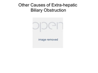 Other Causes of Extra-hepatic
      Biliary Obstruction
 