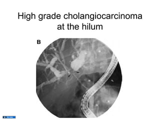 High grade cholangiocarcinoma
         at the hilum
 