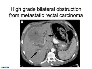 High grade bilateral obstruction
from metastatic rectal carcinoma
 