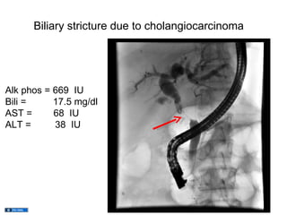 Biliary stricture due to cholangiocarcinoma




Alk phos = 669 IU
Bili =     17.5 mg/dl
AST =      68 IU
ALT =      38 IU
 