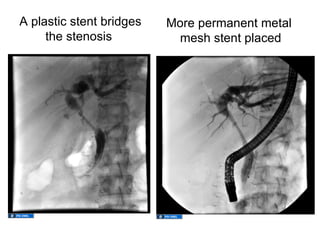 A plastic stent bridges   More permanent metal
     the stenosis           mesh stent placed
 