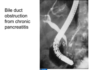 Bile duct
obstruction
from chronic
pancreatitis
 