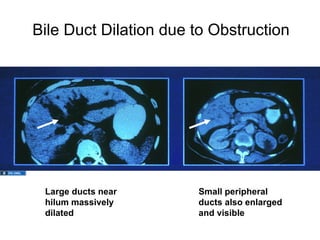 Bile Duct Dilation due to Obstruction




 Large ducts near      Small peripheral
 hilum massively       ducts also enlarged
 dilated               and visible
 