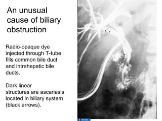 An unusual
cause of biliary
obstruction

Radio-opaque dye
injected through T-tube
fills common bile duct
and intrahepatic bile
ducts.

Dark linear
structures are ascariasis
located in biliary system
(black arrows).
 