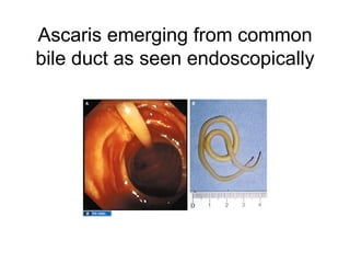 Ascaris emerging from common
bile duct as seen endoscopically
 