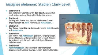 Malignes Melanom: Stadien Clark-Level
 Stadium 0-I
Das Melanom wächst nur in der Oberhaut und hat
noch keine weitere Hautschicht durchbrochen.
 Stadium I
Es liegt ein Tumor vor, der auf höchstens 2 mm
angewachsen ist. Kein Hinweis auf Metastasen.
 Stadium II
Der Tumor misst bis zu 4 mm oder mehr. Kein Hinweis
auf Metastasen.
 Stadium III
Der Tumor hat Metastasen gebildet. Untergruppen
dieses Stadiums unterscheiden sich je nach Art der
Metastasen und danach, wie viele Lymphknoten
befallen sind.
 Stadium IV
Fernmetastasen sind in einem oder mehreren
Organen nachweisbar (Lunge, Leber, Gehirn, Skelett).
 