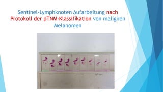 Sentinel-Lymphknoten Aufarbeitung nach
Protokoll der pTNM-Klassifikation von malignen
Melanomen
 