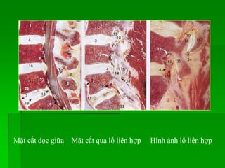 Mặt cắt dọc giữa Mặt cắt qua lỗ liên hợp Hình ảnh lỗ liên hợp
 