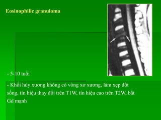 Eosinophilic granuloma
- 5-10 tuổi
- Khối hủy xương không có vòng xơ xương, làm xẹp đốt
sống, tín hiệu thay đổi trên T1W, tín hiệu cao trên T2W, bắt
Gd mạnh
 