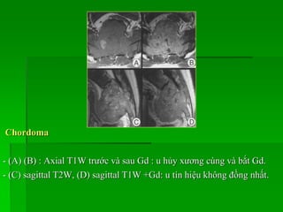 Chordoma
- (A) (B) : Axial T1W trước và sau Gd : u hủy xương cùng và bắt Gd.
- (C) sagittal T2W, (D) sagittal T1W +Gd: u tín hiệu không đồng nhất.
 