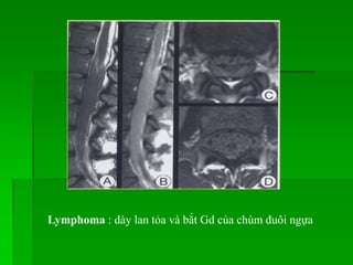 Lymphoma : dày lan tỏa và bắt Gd của chùm đuôi ngựa
 
