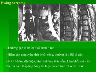 - Thường gặp ở 10-20 tuổi, nam > nữ.
- Hiếm gặp u nguyên phát ở cột sống, thường là u ES di căn.
- MRI: không đặc hiệu, hình ảnh hủy thân sống kèm khối mô mềm
lớn, tín hiệu thấp hay đồng tín hiệu với cơ trên T1W và T2W.
Ewing sarcoma
 