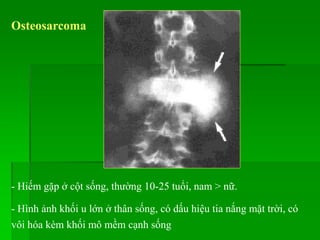 Osteosarcoma
- Hiếm gặp ở cột sống, thường 10-25 tuổi, nam > nữ.
- Hình ảnh khối u lớn ở thân sống, có dấu hiệu tia nắng mặt trời, có
vôi hóa kèm khối mô mềm cạnh sống
 