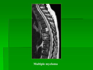 Multiple myeloma
 