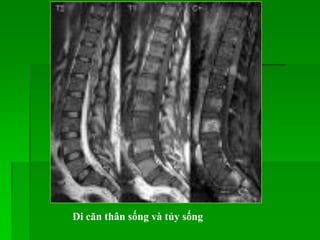 Di căn thân sống và tủy sống
 