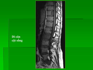 Di căn
cột sống
 