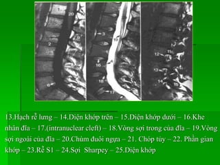 13.Hạch rễ lưng – 14.Diện khớp trên – 15.Diện khớp dưới – 16.Khe
nhân đĩa – 17.(intranuclear cleft) – 18.Vòng sợi trong của đĩa – 19.Vòng
sợi ngoài của đĩa – 20.Chùm đuôi ngựa – 21. Chóp tủy – 22. Phần gian
khớp – 23.Rễ S1 – 24.Sợi Sharpey – 25.Diện khớp
 