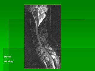 Di căn
cột sống
 