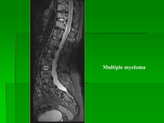 Multiple myeloma
 