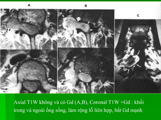 Axial T1W không và có Gd (A,B), Coronal T1W +Gd : khối
trong và ngoài ống sống, làm rộng lỗ liên hợp, bắt Gd mạnh
 