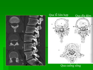 Qua lỗ liên hợp Qua đĩa đệm
Qua cuống sống
 