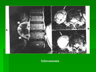 Schwannoma
 