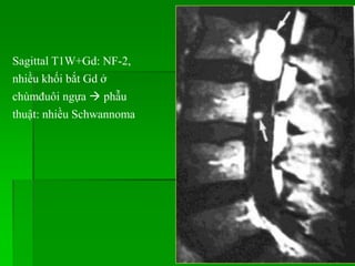 Sagittal T1W+Gd: NF-2,
nhiều khối bắt Gd ở
chùmđuôi ngựa  phẫu
thuật: nhiều Schwannoma
 