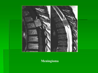 Meningioma
 