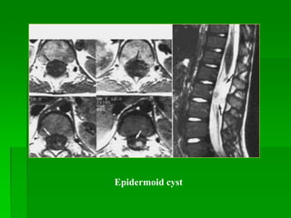 Epidermoid cyst
 