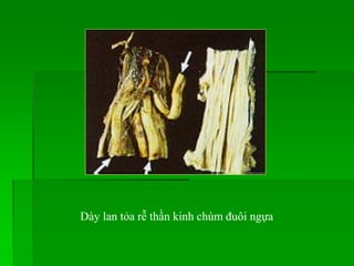 Dày lan tỏa rễ thần kinh chùm đuôi ngựa
 