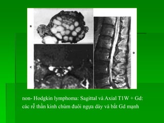 non- Hodgkin lymphoma: Sagittal và Axial T1W + Gd:
các rễ thần kinh chùm đuôi ngựa dày và bắt Gd mạnh
 