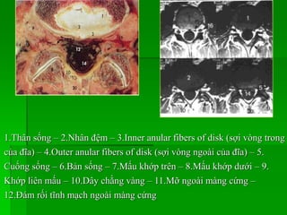 1.Thân sống – 2.Nhân đệm – 3.Inner anular fibers of disk (sợi vòng trong
của đĩa) – 4.Outer anular fibers of disk (sợi vòng ngoài của đĩa) – 5.
Cuống sống – 6.Bản sống – 7.Mấu khớp trên – 8.Mấu khớp dưới – 9.
Khớp liên mấu – 10.Dây chằng vàng – 11.Mỡ ngoài màng cứng –
12.Đám rối tĩnh mạch ngoài màng cứng
 