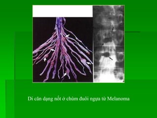Di căn dạng nốt ở chùm đuôi ngựa từ Melanoma
 