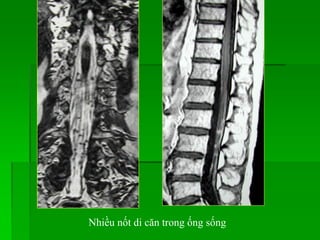 Nhiều nốt di căn trong ống sống
 