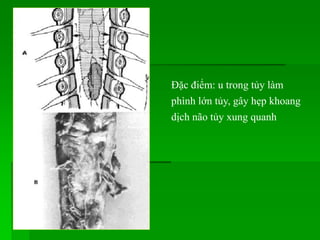 Đặc điểm: u trong tủy làm
phình lớn tủy, gây hẹp khoang
dịch não tủy xung quanh
 