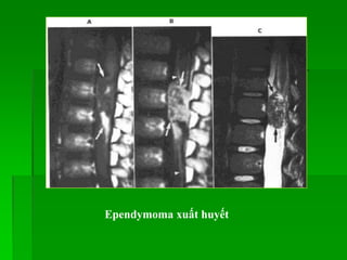 Ependymoma xuất huyết
 