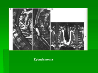 Ependymoma
 