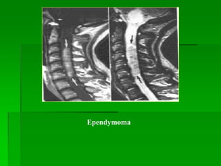 Ependymoma
 