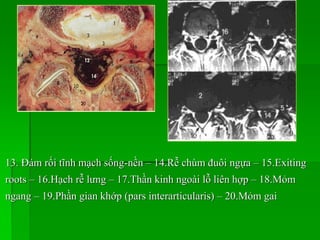 13. Đám rối tĩnh mạch sống-nền – 14.Rễ chùm đuôi ngựa – 15.Exiting
roots – 16.Hạch rễ lưng – 17.Thần kinh ngoài lỗ liên hợp – 18.Mỏm
ngang – 19.Phần gian khớp (pars interarticularis) – 20.Mỏm gai
 