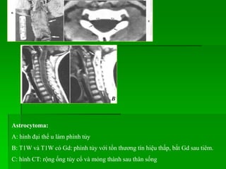 B
Astrocytoma:
A: hình đại thể u làm phình tủy
B: T1W và T1W có Gd: phình tủy với tổn thương tín hiệu thấp, bắt Gd sau tiêm.
C: hình CT: rộng ống tủy cổ và mỏng thành sau thân sống
 