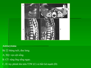 Astrocytoma
Bé 22 tháng tuổi, đau lưng.
A; XQ: vẹo cột sống.
B: CT: rộng ống sống ngực.
C, D: tủy phình lớn trên T2W (C) và bắt Gd mạnh (D)
 
