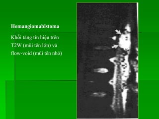 Hemangiomablstoma
Khối tăng tín hiệu trên
T2W (mũi tên lớn) và
flow-void (mũi tên nhỏ)
 