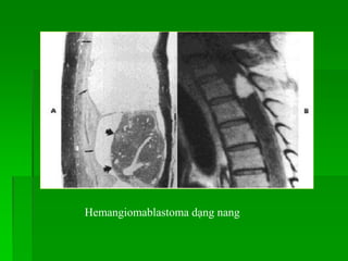 Hemangiomablastoma dạng nang
 