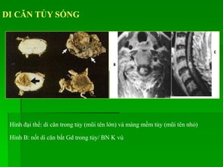 DI CĂN TỦY SỐNG
Hình đại thể: di căn trong tủy (mũi tên lớn) và màng mềm tủy (mũi tên nhỏ)
Hình B: nốt di căn bắt Gd trong tủy/ BN K vú
 